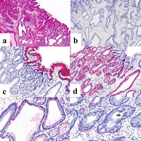 Endoscopic Appearance Of The Nodular Malignant Lesion In The Stomach