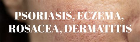 Psoriasis Eczema Rosacea Dermatitis Beautyologist