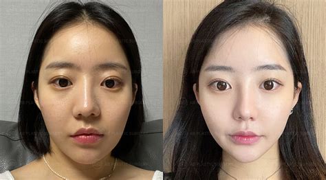 Square jaw surgery, frontal chin surgery, and reduction of prominent cheekbones.