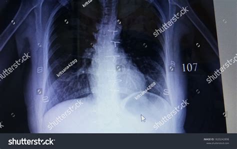 Xray Film Stents Hold Sternum After Stock Photo 1820242898 Shutterstock