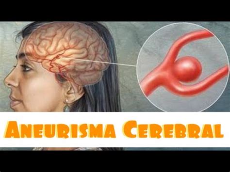 Aneurisma Cerebral Familiar ANEURISMA CEREBRAL Dr Julio Pereira