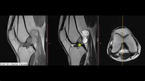 Acl Mucoid Myxoid Degenerative Changes With Ganglion Cyst Youtube