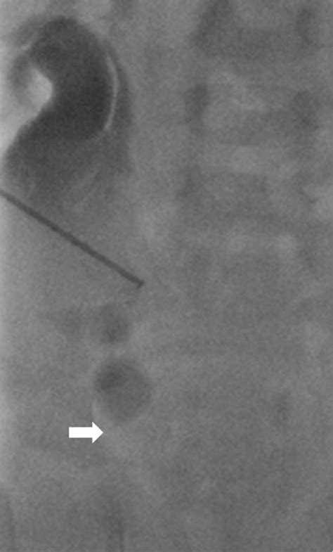 Figure 1 from Percutaneous Anterior Ureterostomy for Double J Ureteral Stent Placement in an 18 ...