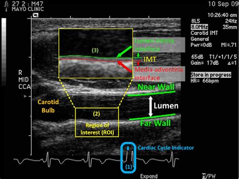 Figure 1 From Automating Carotid Intima Media Thickness Video