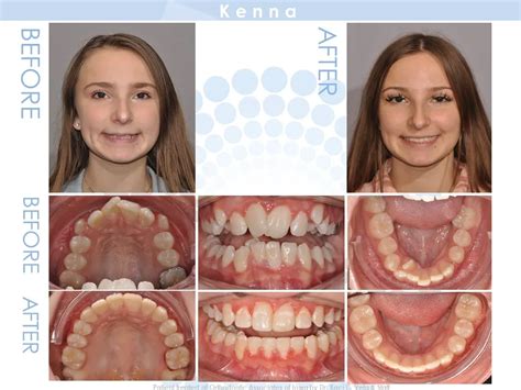 Braces Before And After