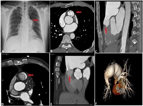 Diagnostics Free Full Text Ct Imaging Findings Of Pulmonary Artery Stenosis A Pictorial Review