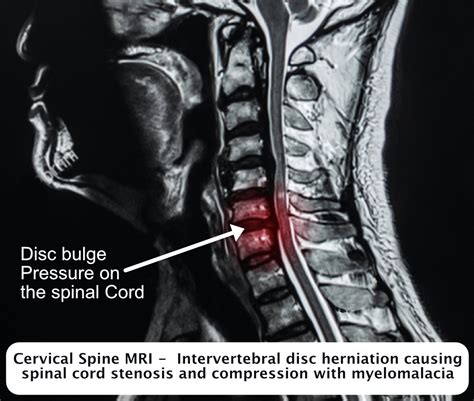 Cervical Myelopathy Back Care Clinic