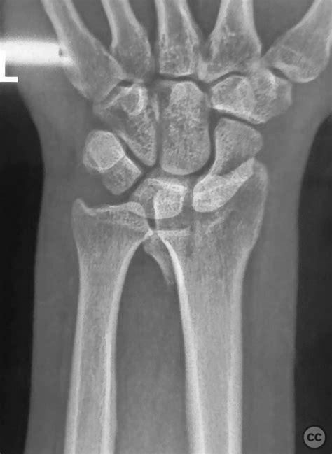 Volar Barton Fracture Dislocation Distal Radius