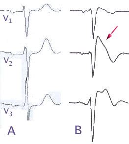 Brugada Brugada Syndrom