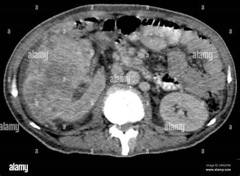Renal Carcinoma Ct Scan Stock Photo Alamy