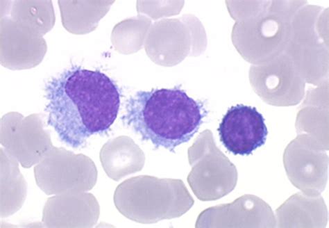 Cytological Aspects Of Hairy Cell Leukemia Hcl Courtesy To Dr