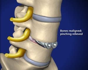 Anterior Lumbar Interbody Fusion Midwest Neurosurgery Kansas City MO