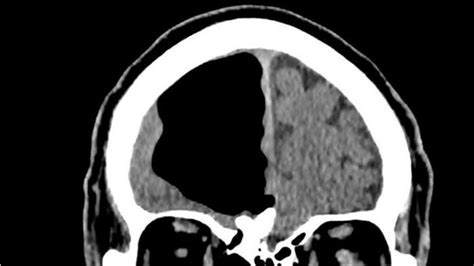 Dinyatakan Sehat Dokter Syok Saat Lihat Hasil Ct Scan Tunjukkan Otak