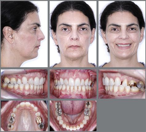 Scielo Brasil Influence Of Risedronate On Orthodontic Tooth