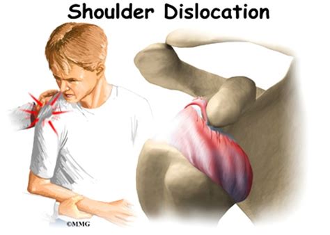 Shoulder Dislocation Symptoms And Treatment