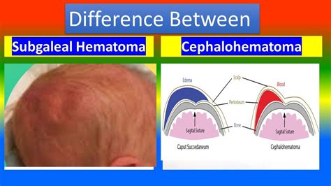 Caput Succedaneum Vs Cephalohematoma