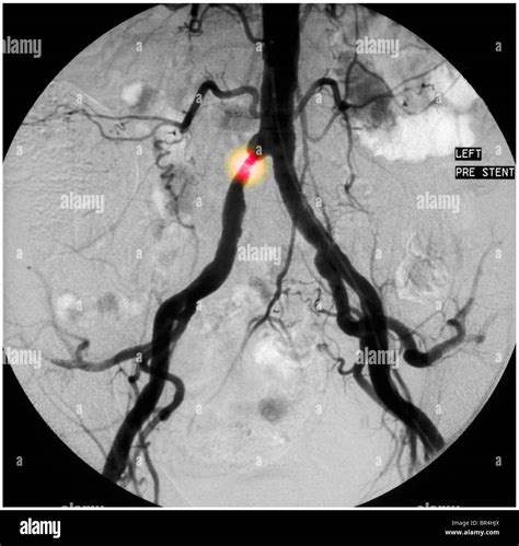 Obturator Artery Angiogram