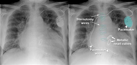 Chest X Ray Cardiac Disease Cardiac Surgery Artifact