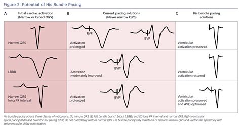 Figure 2: Potential of His Bundle Pacing | Radcliffe Cardiology