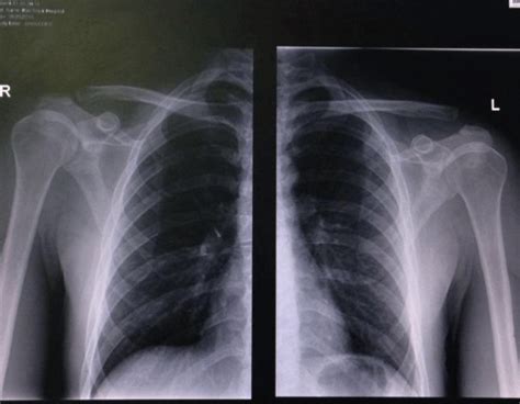 X Ray Left Shoulder Ap View Download Scientific Diagram