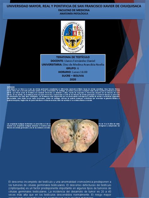 Teratoma De Testiculo Pdf Neoplasias Cáncer