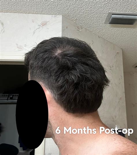 My Journey So Far 6 Month Ht And 3 Years Finasteride Minoxidil R Tressless