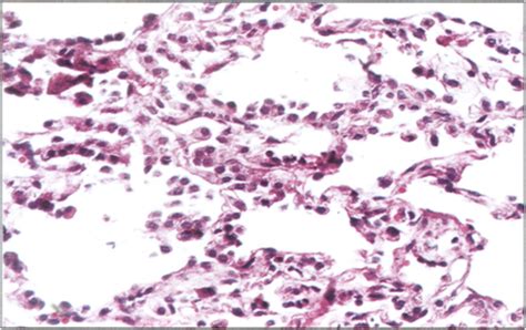 Pulmonary Atypical Adenomatous Hyperplasia And Bronchioloalveolar Carcinoma Cancer Biology