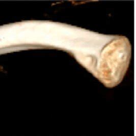 Zanca View Radiograph For Evaluation Of The Injury Pattern Of CC