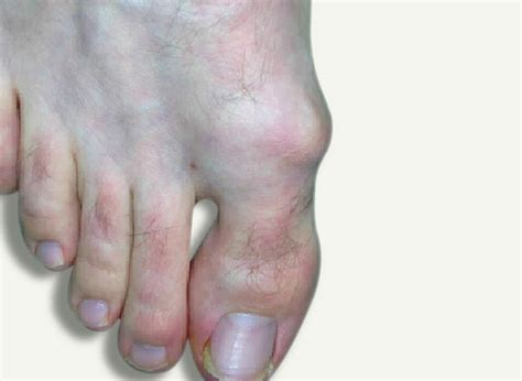 Hallux Limitus Davenport House Clinic