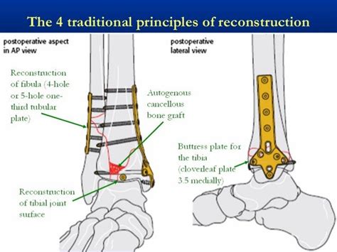 39 Tibial Plafond Pilon Fractures