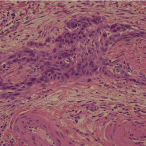 Vulvar Squamous Cell Carcinoma Invasion Of Perineurium And Endoneurium