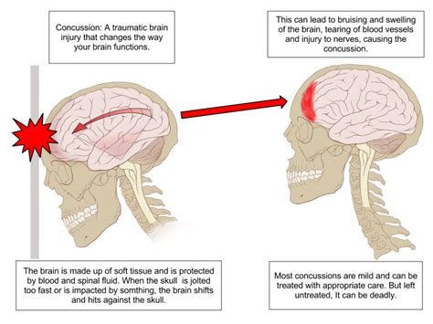 More than just a head injury: brain damage – Golden Arrow