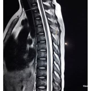 Mri Of The Thoracic Spine In Sagittal And Axial Views At The Levels Of