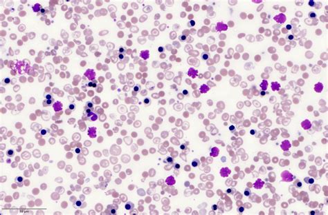 Haemoglobinopathies Learnhaem Haematology Made Simple