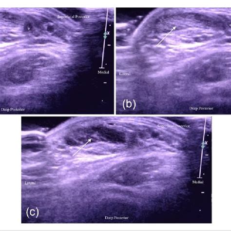 (a) Ultrasound imaging demonstrating the Achilles tendon (arrow) and ...