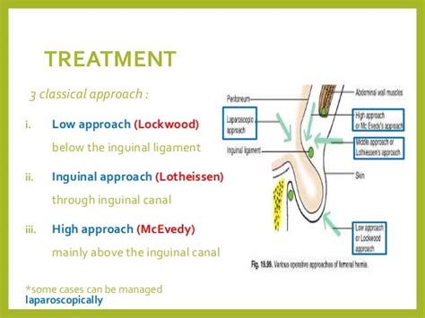 Femoral Hernia Repair Technique