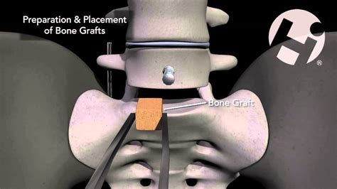 L5 S1 Anterior And Posterior Discectomy And Spinal Fusion Youtube