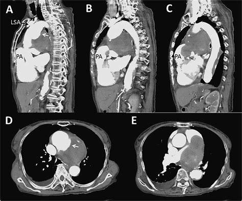 Preoperative Computed Tomography Images The Sagittal Images Showed The