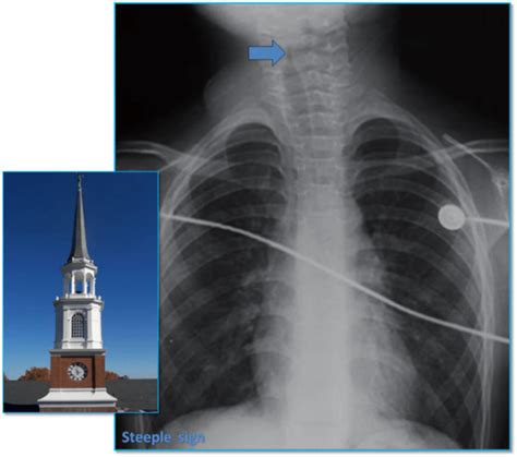 Steeple Sign - radRounds Radiology Network