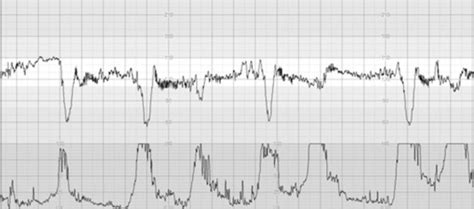 Intrapartum Fetal Surveillance A Physiological Approach Obstetrics