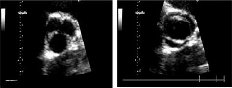 Aortic And Left Ventricular Remodeling In Patients With Bicuspid Aortic Valve Without