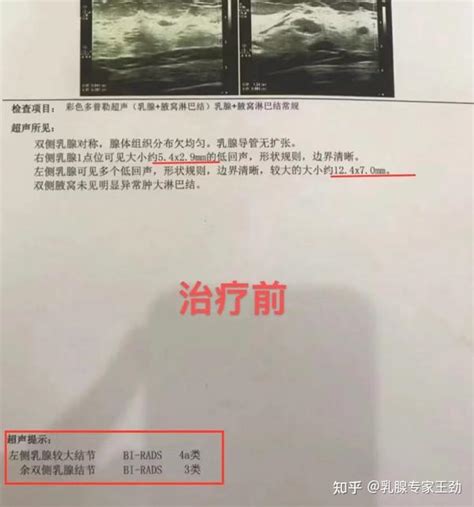 穆女士积极调理3个月，左侧乳腺结节变小了，右侧的消失了！ 知乎