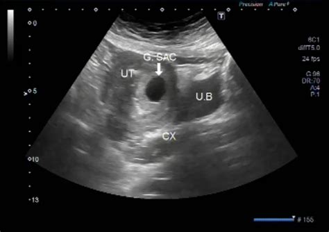 6 Things To Expect At 7 Week Ultrasound Fetal Vision Imaging