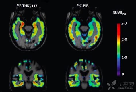 早期诊断阿尔茨海默病的7大影像标记物，值得收藏！ 丁香园