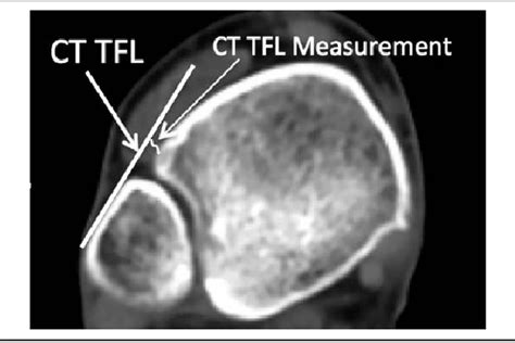 Figure 1 From Clinical Adaptation Of The “tibiofibular Line” For