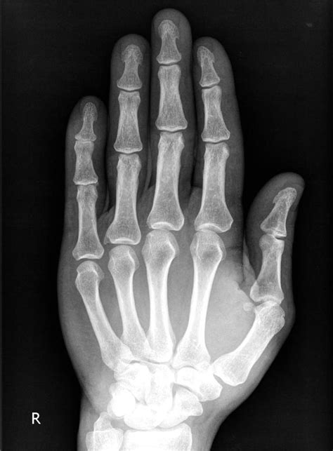 Broken Middle Finger X Ray