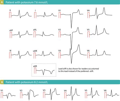 ST segment elevation in acute myocardial ischemia and differential ...