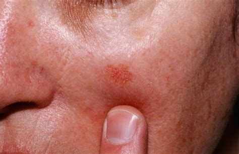 Queratosis actínica causas síntomas y tratamiento