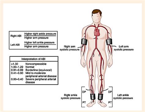 Ankle Brachial Index Measurement Download Scientific Diagram