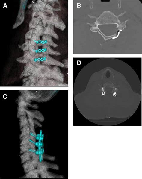 Computed Tomography Of The Cervical Spine After Open Door Laminoplasty